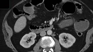 Gallstone ileus [upl. by Marko424]