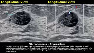 Fibroadenoma Breast Ultrasound Report Example  Benign Tumors USG Scan Report Findings amp Impression [upl. by Ellirpa653]