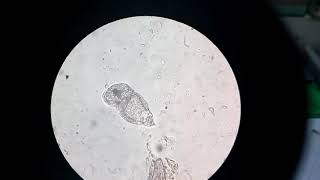 Urine in Scistosoma haematobium [upl. by Fadas]