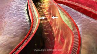 Assista a aula sobre Aterosclerose simulada na nova Lousa 3D Estereoscópico [upl. by Anaeg]