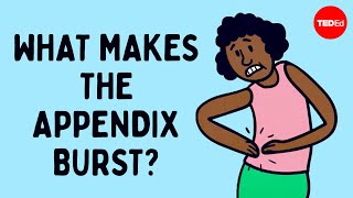 What does appendix pain feel like  David R Flum [upl. by Pittel490]