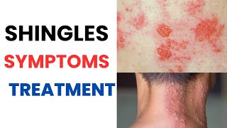 Herpes Zoster Shingles Symptoms Treatment Vaccine Contagious Rash Pain Relief Medication [upl. by Drusie]