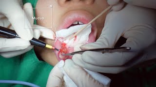 Mucocele removal surgery 입술점액낭종  JUDITH PS KOREA 유디트성형외과 [upl. by Ramas]