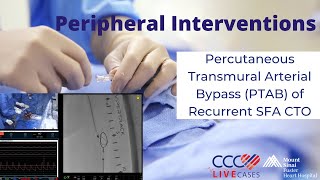 Percutaneous Transmural Arterial Bypass PTAB of Recurrent SFA CTO [upl. by Gujral781]