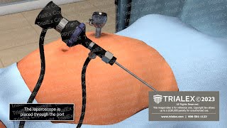 Insertion of Laparoscopic Trocar Animation [upl. by Marx]