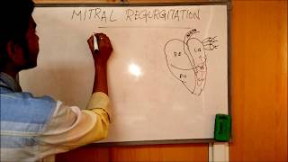 MITRAL REGURGITATION  DEFINITIONCAUSESSIGNSSYMPTOMSPATHOPHYSIOLOGY AND TREATMENT [upl. by Shirl]