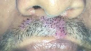 Designer natural growing Moustache video  Dr Sunil Richardson [upl. by Arodoet]