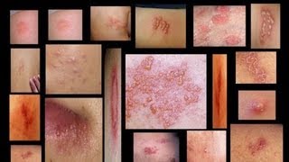 Genital Herpes Symptoms Men and Women  Home Testing  Herpes Treatment Cure Facts [upl. by Nicola]