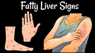 12 Signs Of Fatty Liver Disease You Should Never Ignore [upl. by Elocal]