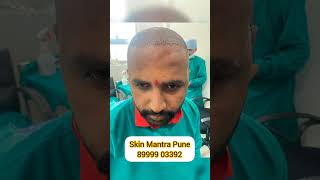 Hair transplant result [upl. by Affay]