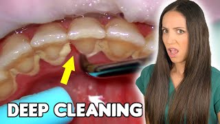 Deep Cleaning With HEAVY Tartar Build Up At The Dentist [upl. by Schlicher521]