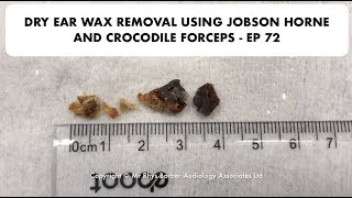 DRY EAR WAX REMOVAL USING JOBSON HORNE AND CROCODILE FORCEPS  EP 72 [upl. by Agretha]