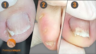 3 cases 1 video III  Lateral spicule extraction  Helomas x 2  Toenail trimming and cleaning [upl. by Anitnegra]