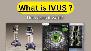 What is IVUS Intra Vascular Ultrasound amp How does it work [upl. by Ocinom]