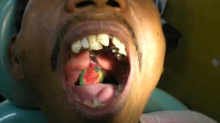 Dr Pankaj Kharade Pharyngeal obturator impression [upl. by Peti657]