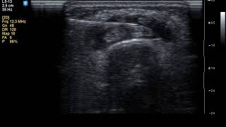 Ultrasound guided injection of corticosteroids for Proximal Intersection Syndrome [upl. by Brad]