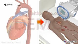 시연용 c0049aako대한심장학회 대동맥내 풍선펌프IABP삽입시술 안내동의서용 [upl. by Greenberg545]