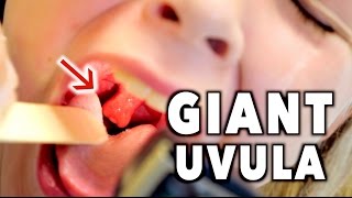 GIANT UVULA Bad Throat Infection  Dr Paul [upl. by Ahsaela758]