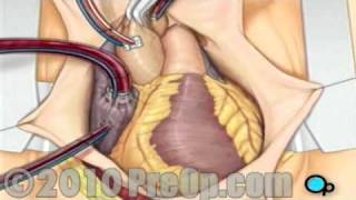 PreOp® Patient Education Coronary Artery Bypass Graft CABG Surgery [upl. by Veriee]