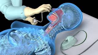 Nasotracheal suctioning NTS  3D animation [upl. by Revorg]