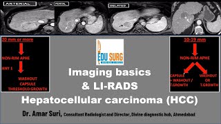 Imaging for Liver Cancer amp LIRADS Hepatocellular carcinoma radiology masterclass  Edusurg clinics [upl. by Kenwee]