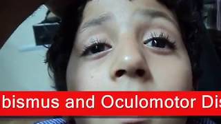 Chronic Progressive External Ophthalmoplegia  شلل عضلات العين [upl. by Aldous193]