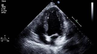 The EchoWeb  Patient Diagnosed with LV Diastolic Dysfunction and Reduced EF [upl. by Doerrer836]