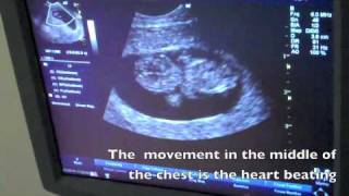 9 week ultrasound [upl. by Sarat]