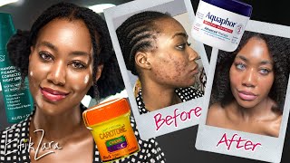 My Skincare Routine for Acne Hyperpigmentation Scars and Antiaging  EfikZara [upl. by Eardnaed]