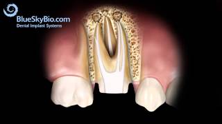 Patient Treatment Videos Root Canal Retreatment [upl. by Labina]