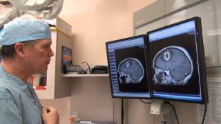 Brain Surgery with Dr Mark Matishak  02 MRI scan with tumour [upl. by Dlonyer]