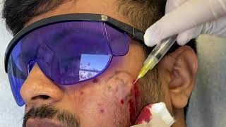 Subcision for Acne Scars [upl. by Aitnwahs598]