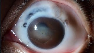 RHEUMATOID ARTHRITS amp EYE SCLERITIS [upl. by Ahseele]