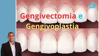 Gengivectomia e Gengivoplastia dralexguedes [upl. by Burch]