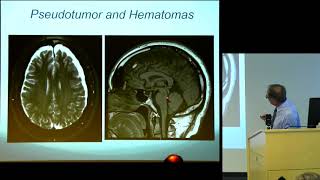 Compound CSF Disorders Hypertension Hypotension and ICP Monitoring [upl. by Erehc]