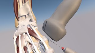 3D Model of a Ultrasound Guided First Metatarsophalangeal Joint Injection by probeultrasound [upl. by Roehm]