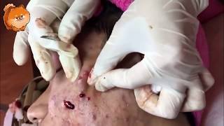 Severe Cystic Acne And Pimples Extraction On Face 2017 Video [upl. by Eula]