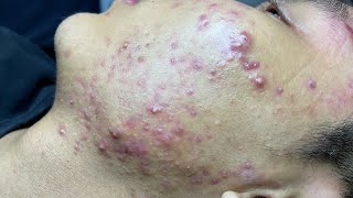 ACNE TREATMENT VU QUYNH MI Blackheads On Boy Face 2024 [upl. by Violetta]