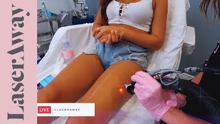 Laser Hair Removal On Legs Live Session At LaserAway [upl. by Etnaled406]