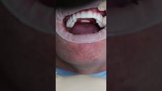 Dental implant’s All on 4 in Prague shorts dentist dental implant veneers short [upl. by Ahsad154]