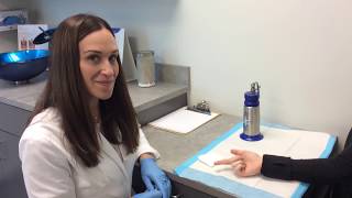 Wart Removal Using Liquid Nitrogen [upl. by Beller]