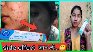 Benzoyl Peroxide Gel 25 Review In Hindi  Uses And Side Effect  miss glossy girl [upl. by Georgeanna]