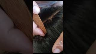 ASMR checking lice and nits and hunting lots of nits👍 part2 [upl. by Eneroc]