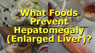 What Foods Prevent Hepatomegaly Enlarged Liver [upl. by Oibesue]