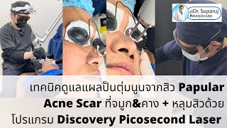 รักษาแผลป็นตุ่มนูนจากสิว Papular Acne Scar ที่จมูกampคาง  หลุมสิว ด้วย โปรแกรม Discovery Pico Laser [upl. by Oaks]