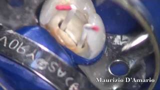 Terapia endodontica premolare [upl. by Siurad6]