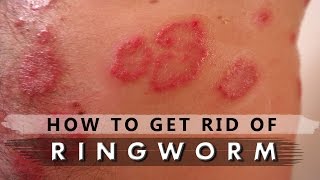 How to get rid of ringworm with home remedies Fast Wringworm treatment [upl. by Anaihr]