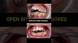 Braces super crooked and openbite teeth braces orthodontist dentist [upl. by Thema322]