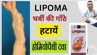 Homeopathic treatment for Lipoma  Lipoma  चर्बी की गांठ  Gath  Gilti गांठों का इलाज बिना ऑपरेशन [upl. by Haran65]