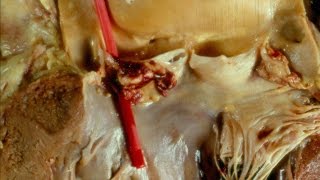 Infective Endocarditis  Pathology mini tutorial [upl. by Frech]